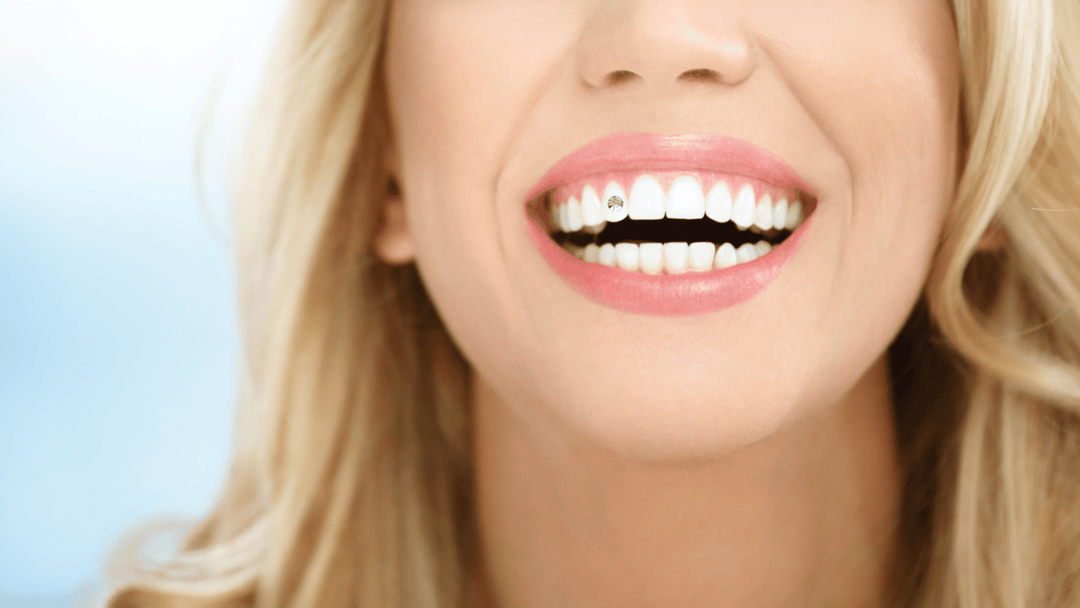 Comment Coller Un Strass Dentaire?